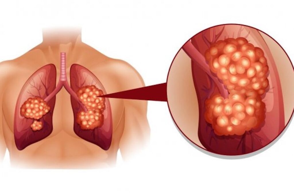 Cancerul pulmonar: Simptome, tratament, rata de supraviețuire, stadii, 7 tipuri, cauze Afecțiuni ale plămânilor